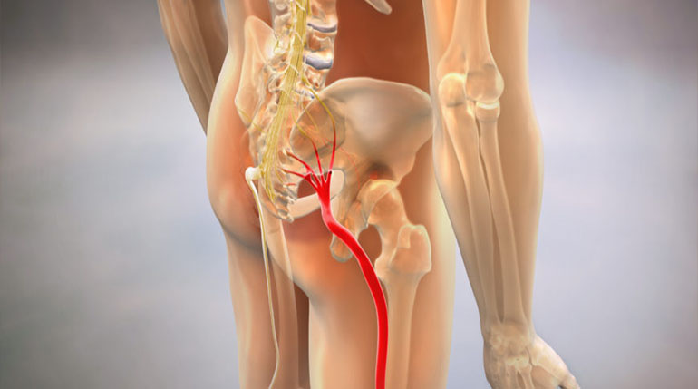 rwa kulszowa co to jest